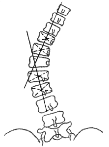 Измерение угла сколиотической дуги по методу Лекума. Сколиоз