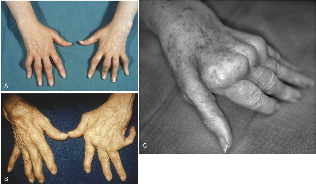 Типичные деформации суставов кистей рук