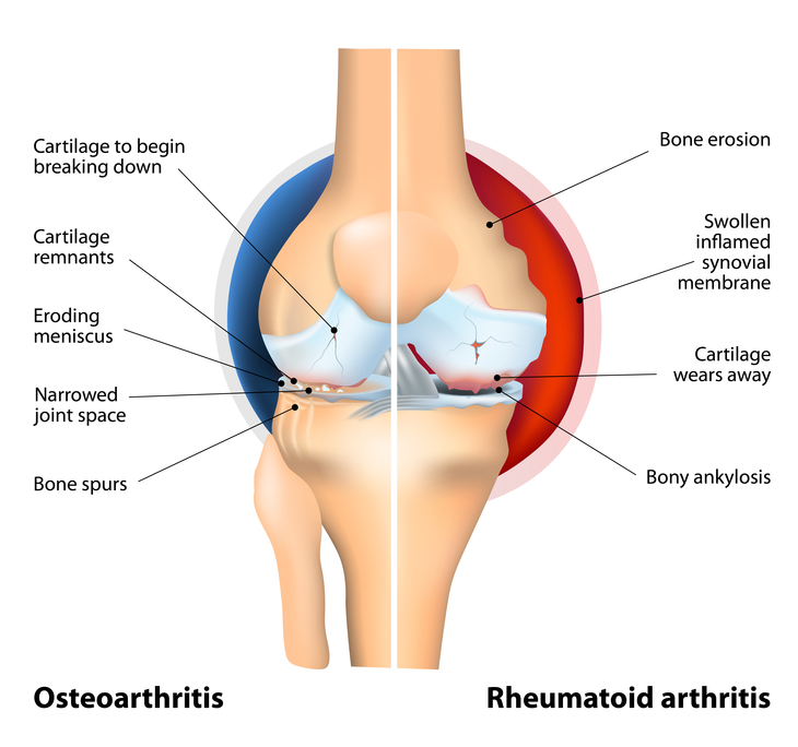 Остеоартрит и ревматоидный артрит коленного сустава