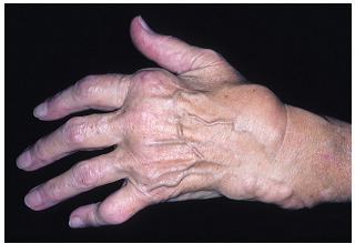 Деформации суставов кистей рук
