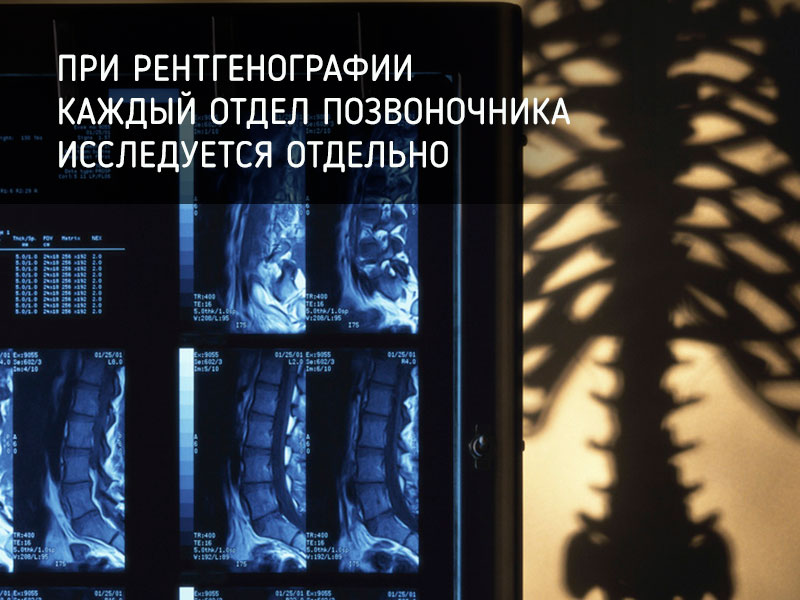 Рентген при остеохондрозе