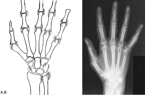 Сайты ранней эрозии суставов кисти и рентгеновский снимок руки с классическими ревматоидными эрозиями