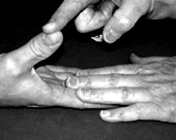 Рука (С8, T1: срединный нерв)