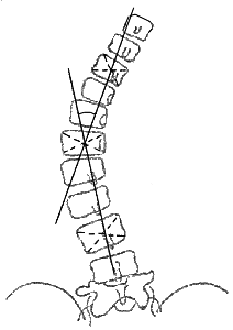 Измерение угла сколиотической дуги по методу Фергюссона. Сколиоз